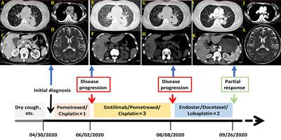 Case Report: Recombinant Human Endostatin Plus Chemotherapy for Epidermal Growth Factor Receptor-Negative Miliary Lung Adenocarcinoma